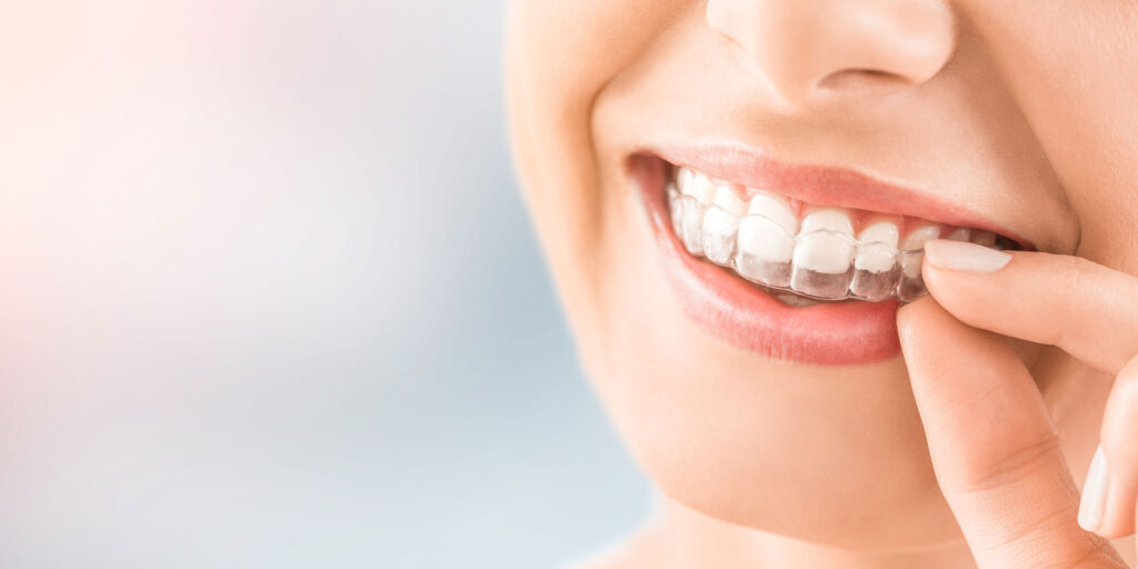 Dental patient wearing invisalign