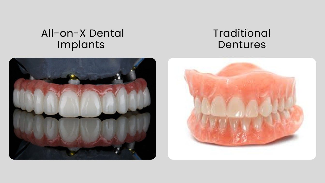 Comparison of dentures versus dental implants