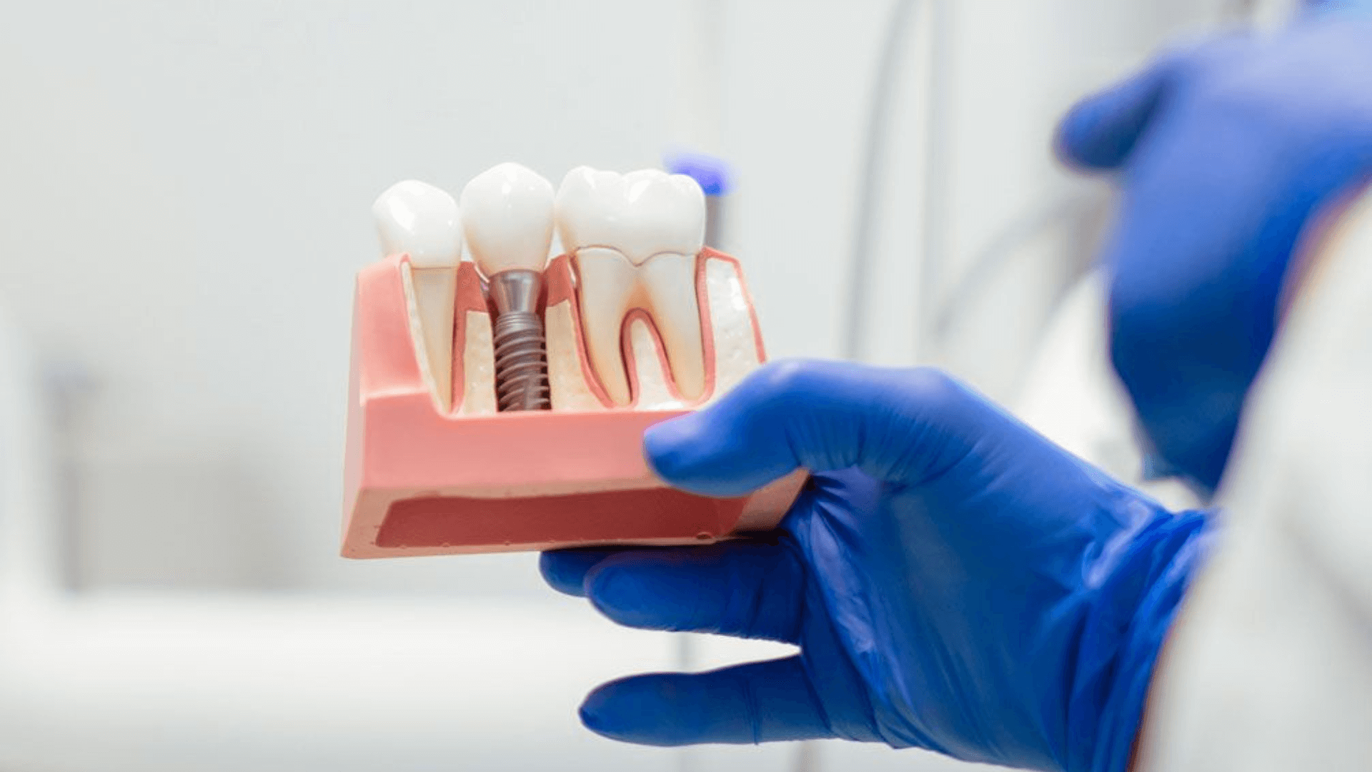 Dental Implants