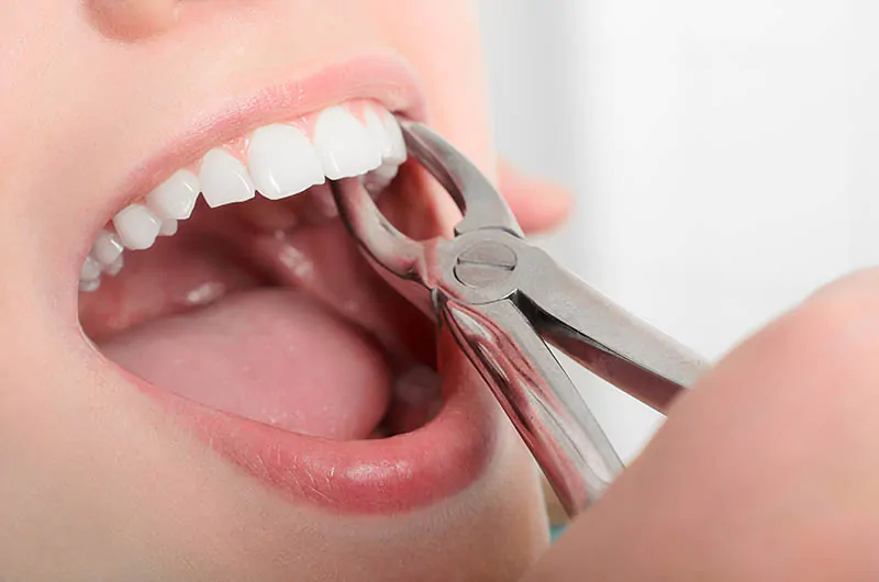 Tooth-Extraction-1