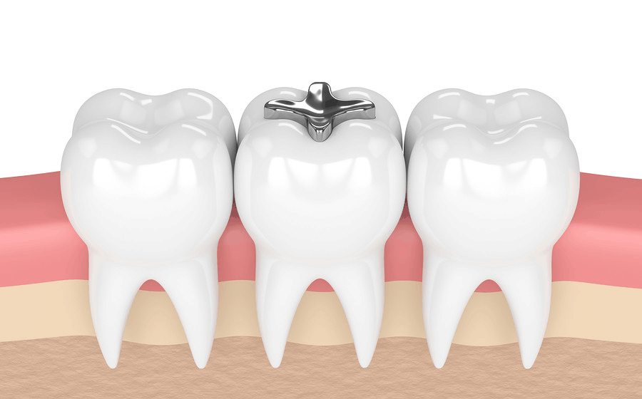 What-is-amalgam-fillings