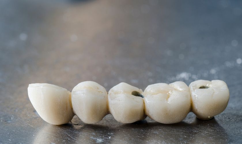 dental-bridge