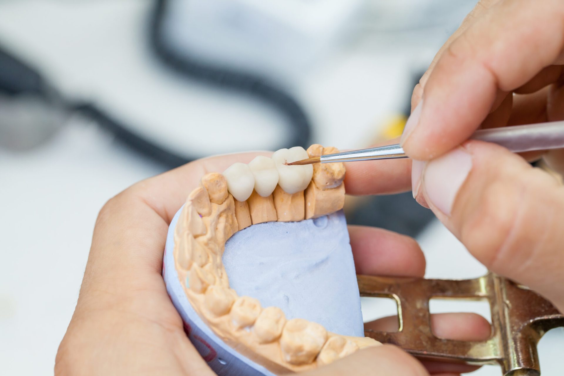 dental-bridges