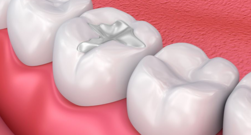 dental_filling-500x270-1