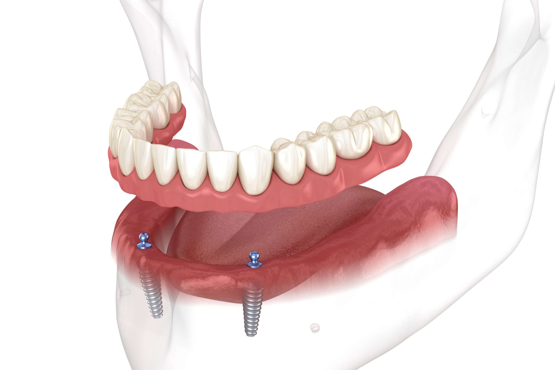 implant-retained-dentures