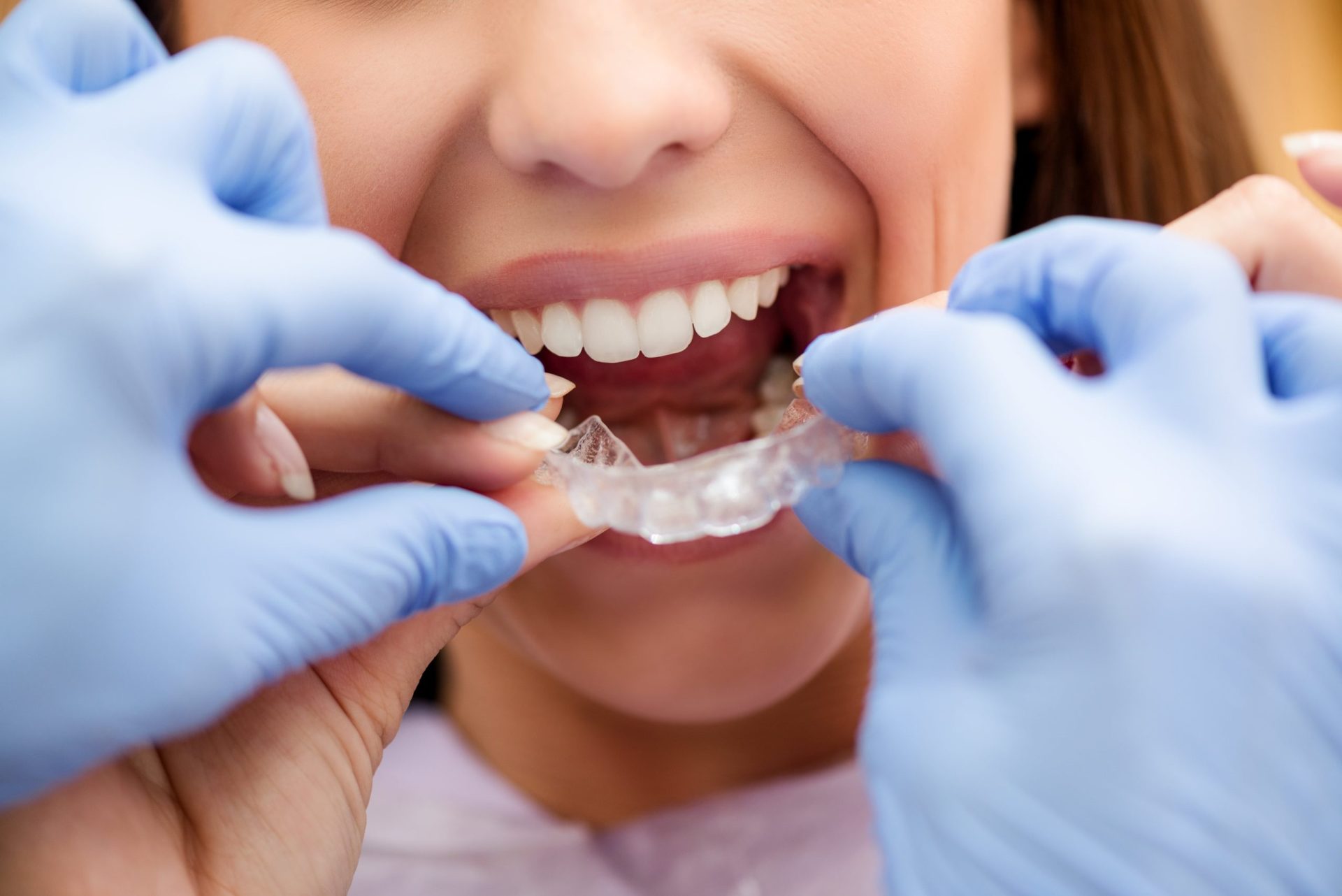 invisible-braces-2023-11-27-04-56-23-utc-min-scaled-1