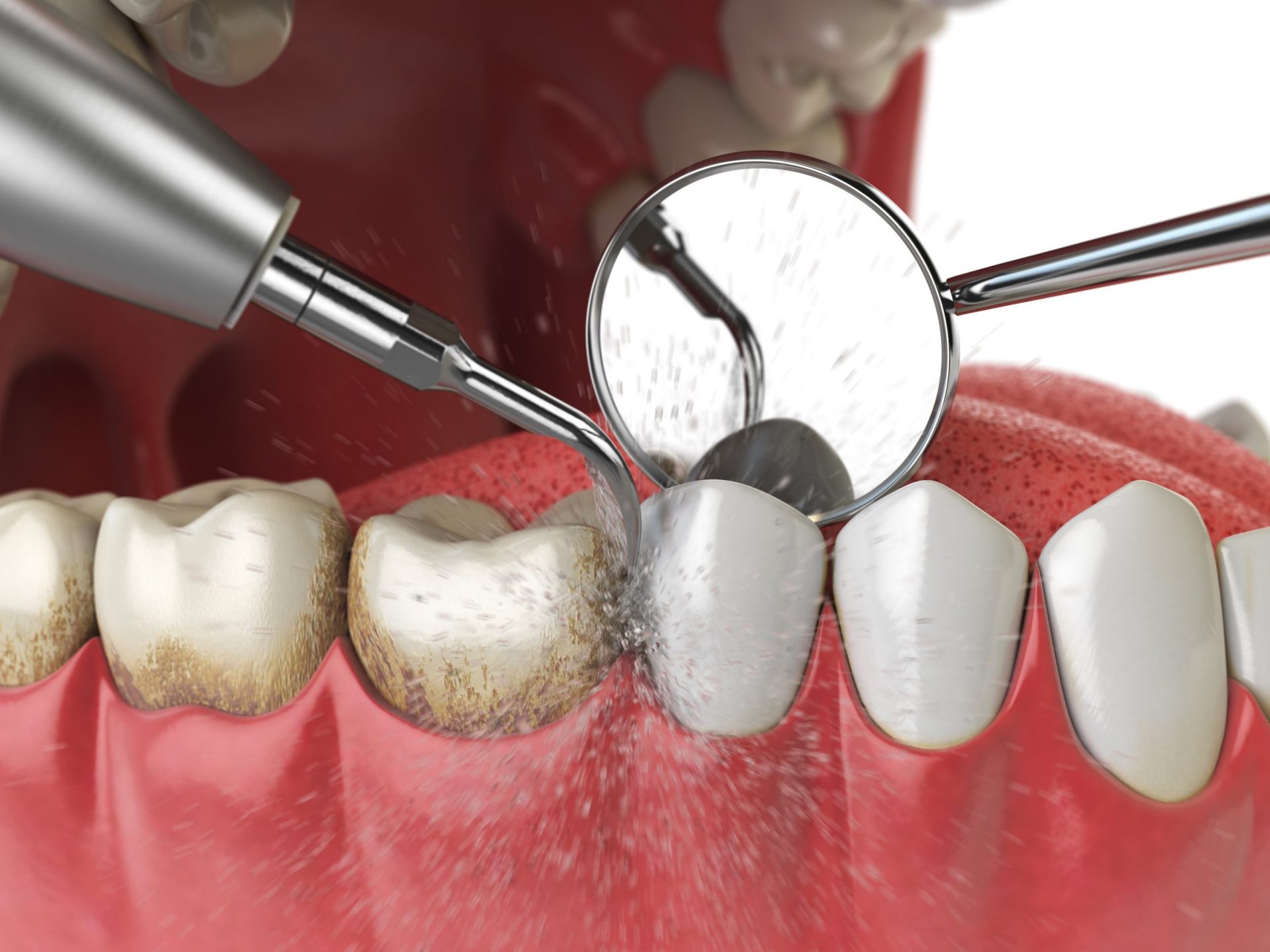 periodontal-maintenance-scaled-1