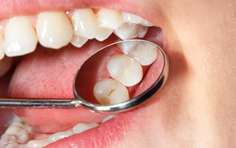 sealants