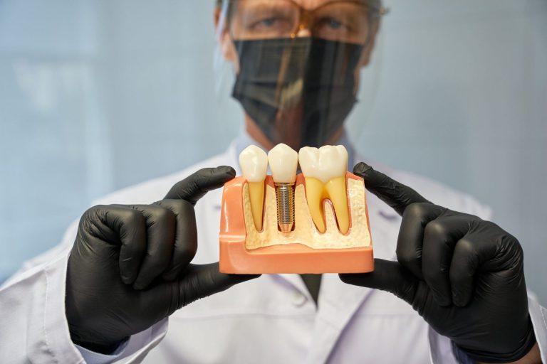 All-on-X Dental Implants: A Modern Solution for Missing Teeth