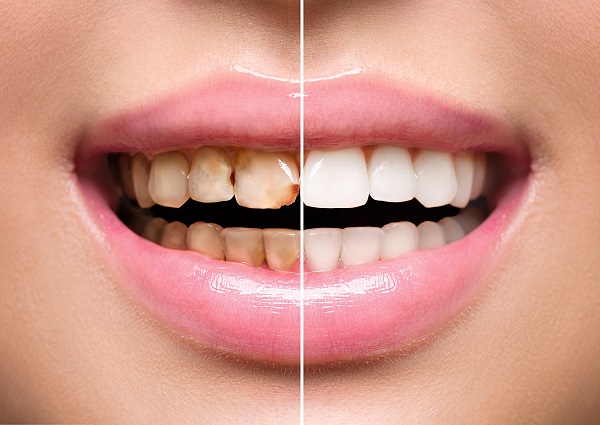Woman,Teeth,Before,And,After,Dental,Treatment.,Teeth,Whitening